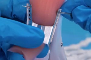 運(yùn)動(dòng)員們的跟腱都是怎么修復(fù)的？這么看起來真的太辛苦了